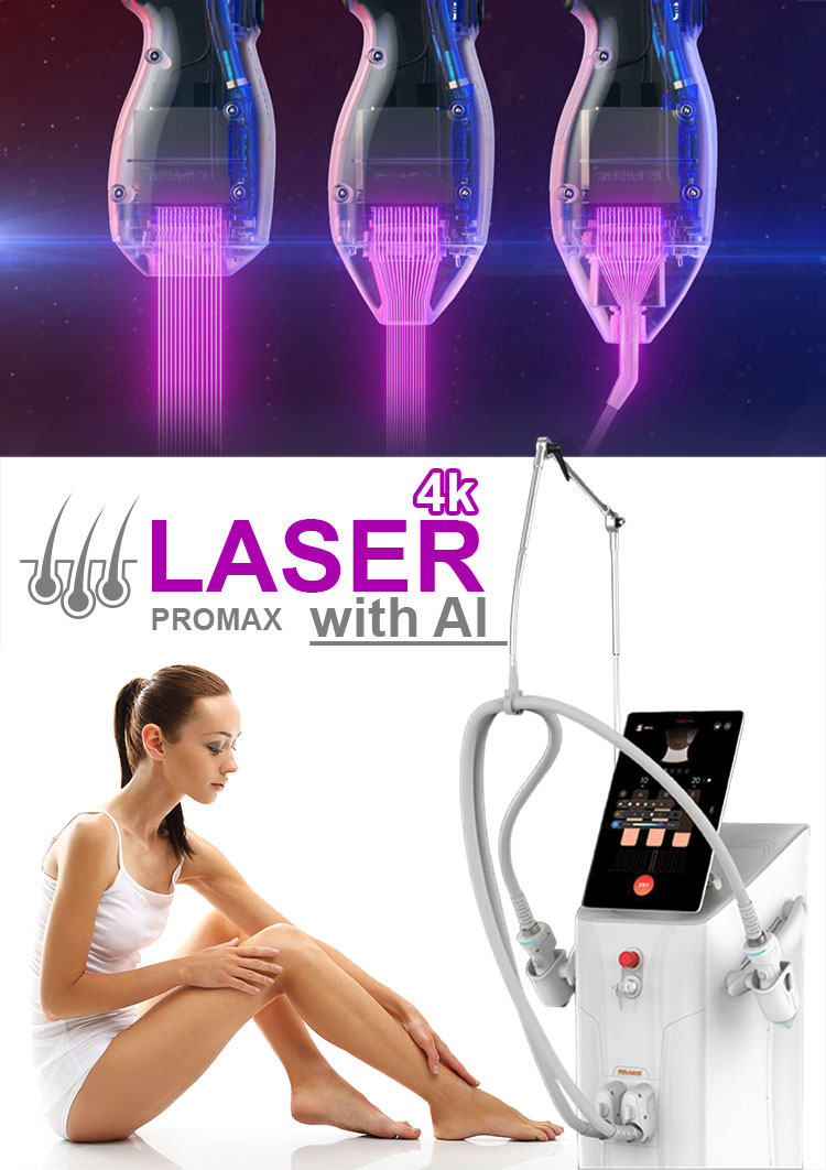 epilare definitiva cu laser in Iasi