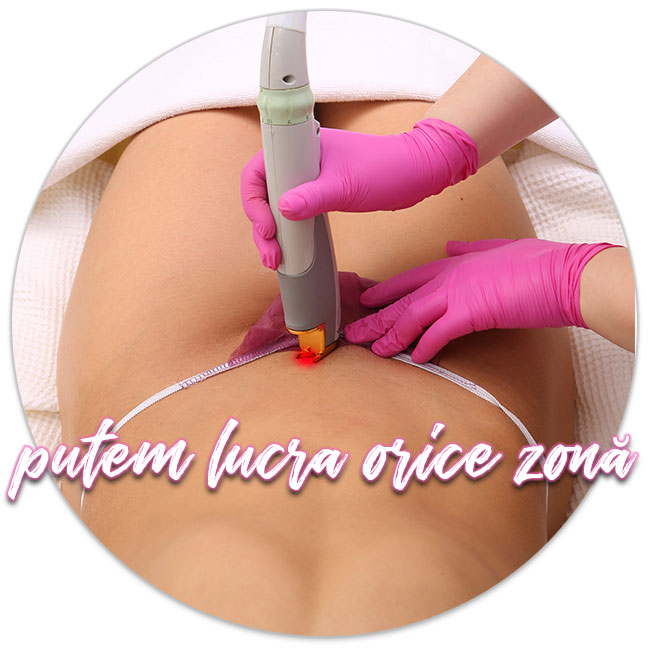 epilare definitiva cu laser in Iasi