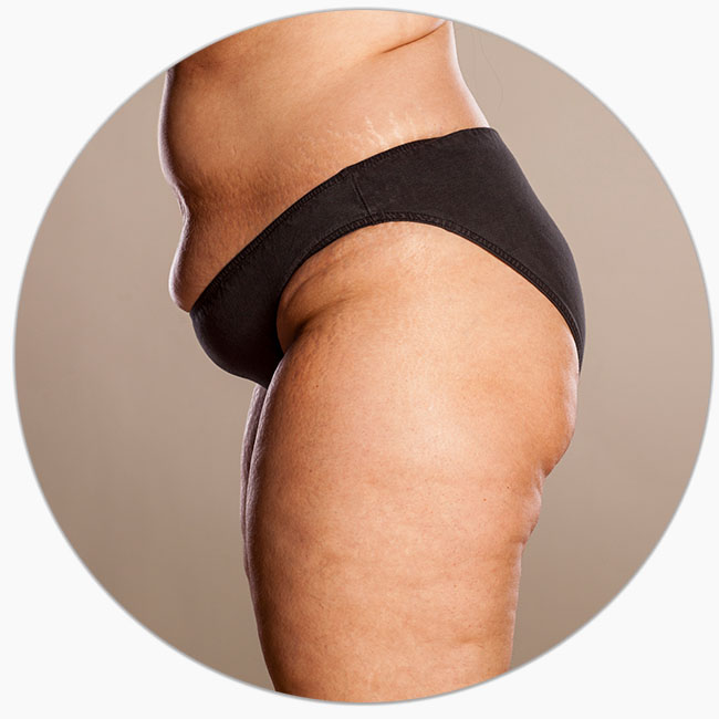 cum sa scapi de grasimea localizata