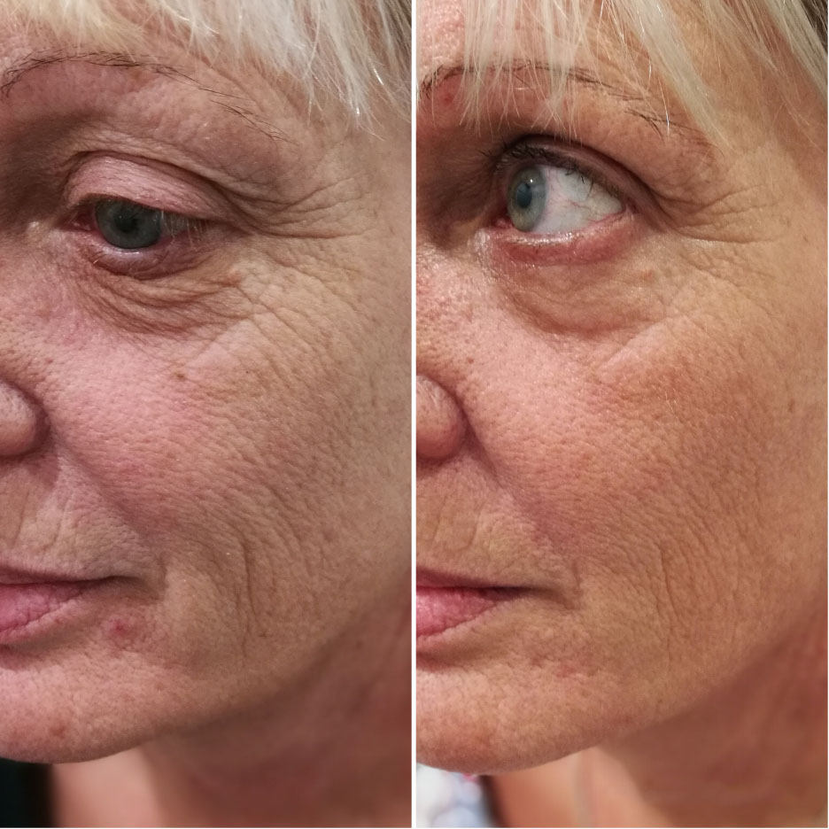 tratamente pentru riduri