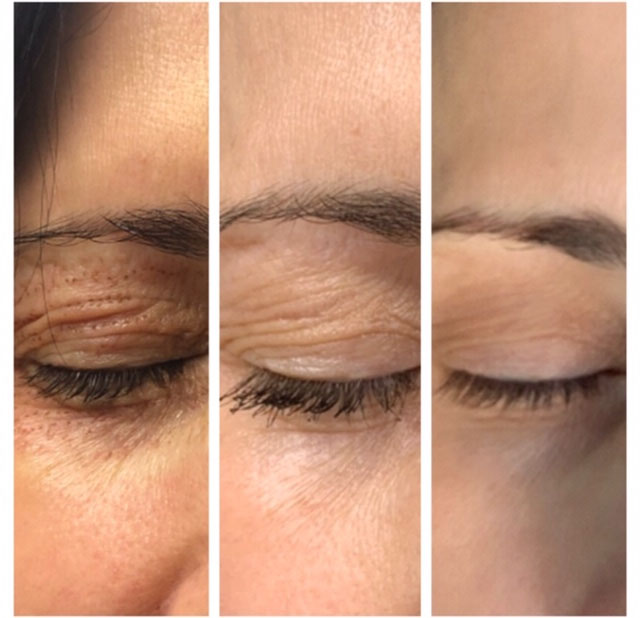 tratamente pentru riduri