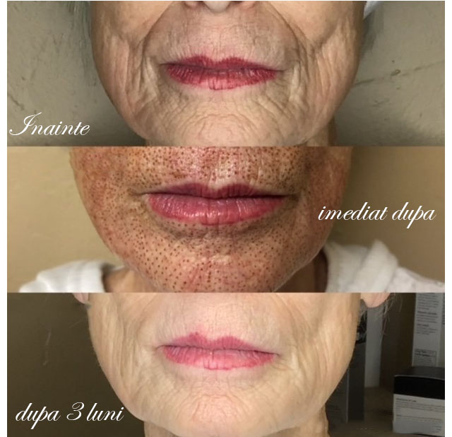 tratamente pentru riduri