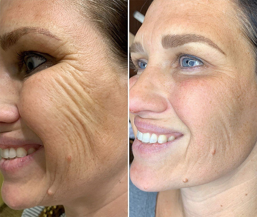 tratamente pentru riduri