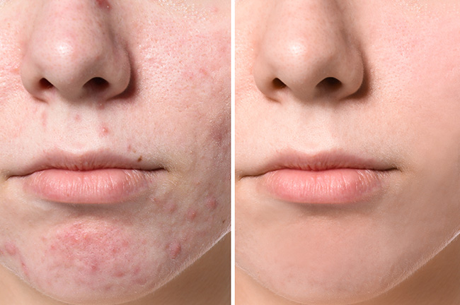 tratamente pentru acnee